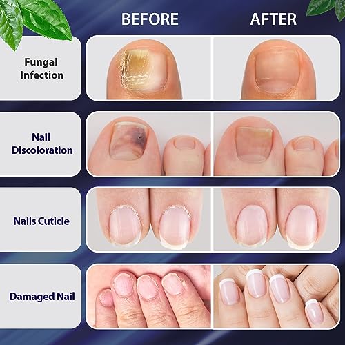 Toenail Fungus Treatment Extra Strength, Toe Fungus Treatment for Toenail, Fungus Nail Treatment, Nail Fungus Treatment for Damaged Nail & Athletes Foot (1oz)