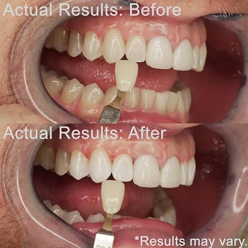 Teeth Whitening Kit | Fast Whitener Gel 44% Carbamide Peroxide | for Discolored, Yellow, Brown, Black, Coffee, Smoking, Intrinisic Deep Stains